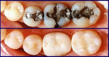 Diferena entre restauraão a amálgama e a compósito