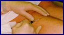 sess&atilde;o de escleroterapia