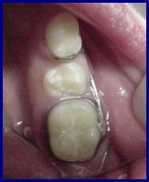 aparelho para manuten�&atilde;o do espa�o ap&oacute;s perda de dente dec&iacute;duo