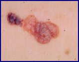 sinal que malignizou tornando-se num melanoma (tumor da pele)