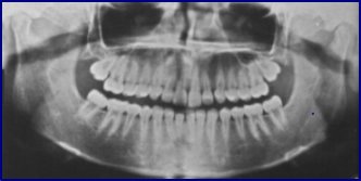 radiografia panormica dos maxilares