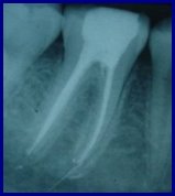 tratamento endod�ntico