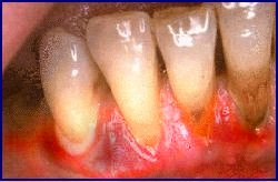 periodontopatia grave