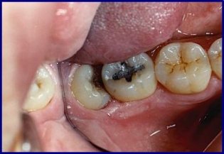 dente do siso inferior malposicionado, causando inflamaão severa e com indicaão para extracão